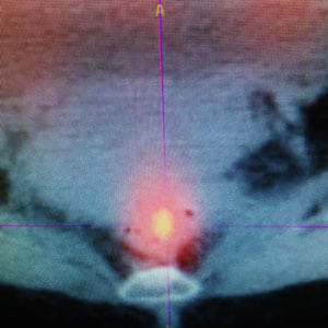 Scan showing bowel cancer